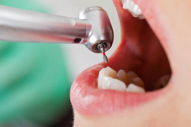 Best Emergency Dentist for Lost Fillings or Crowns in Buchanan Dam, TX